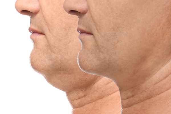 HIFU - Breakthrough in Anti - ageing 2 hifu results Stowmarket