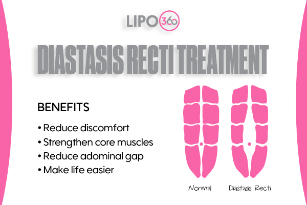 Revolutionising Muscle Repair: The Power of LIPO360 Body Sculpt Post-Injury 5 diastasis recti treatment Stowmarket
