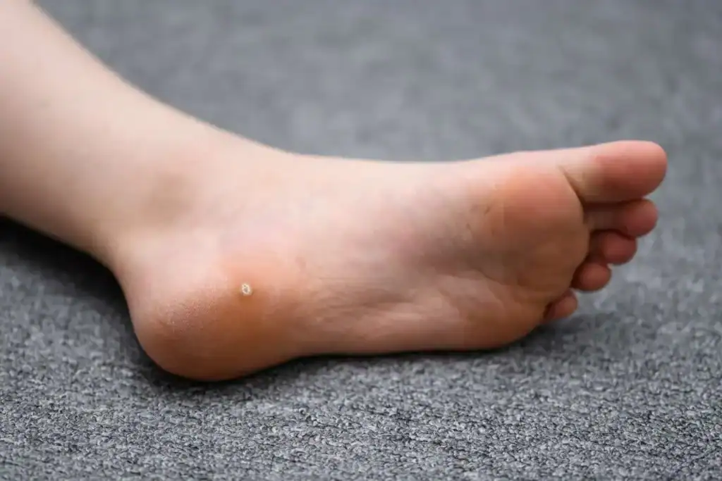 Cryotherapy For Warts And Also Verrucas 2 Image of verruca on the bottom of the foot that able to be treated with Cryotherapy Stowmarket