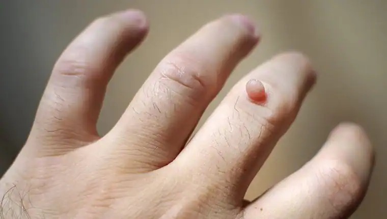 Cryotherapy For Warts And Also Verrucas 1 Image of blemish that Cryotherapy Stowmarket can remove with Lipo 360.