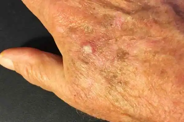 Cryopen For Actinic Keratoses 1 Image of Actinic keratoses Stowmarket on a person hand