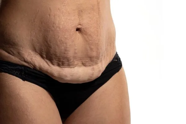 The Science of Skin Tightening 1 The science behind skin tightening Stowmarket picture of a woman's sagging skin on the stomach